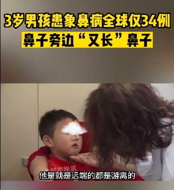 象鼻宝宝罕见病,3岁男孩患象鼻病全球仅34例